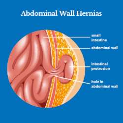 Abdominal Wall Hernias: Understanding Mesh Repair, Complications, and Recovery