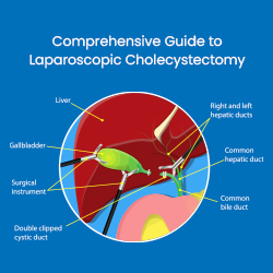 Trilife Laparoscopic Cholecystectomy